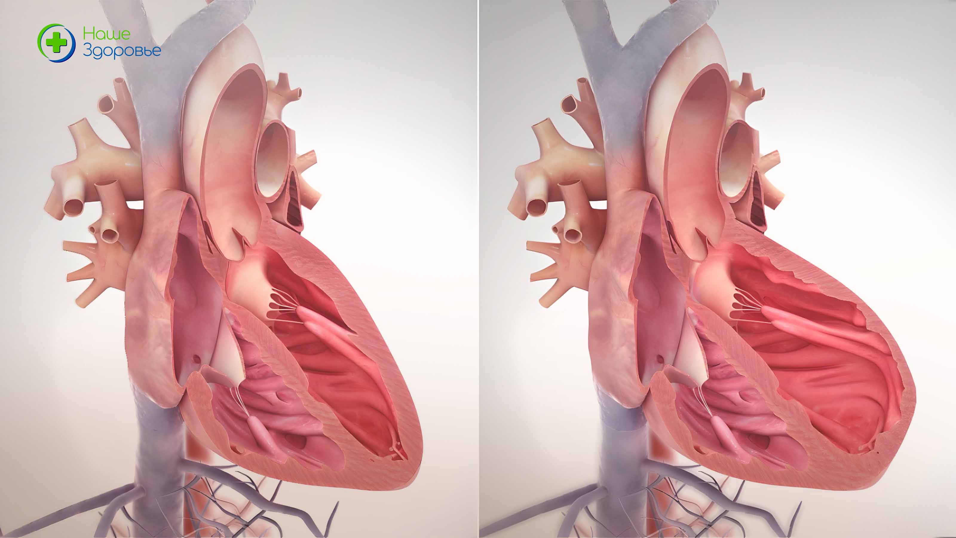 Обычное сердце и с сердечной недостаточностью